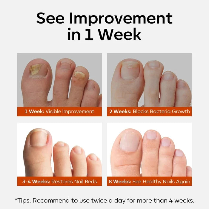 Nail Antifungal Treatment