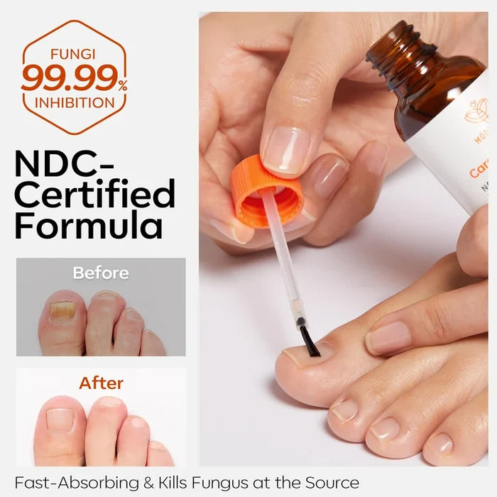 Nail Antifungal Treatment